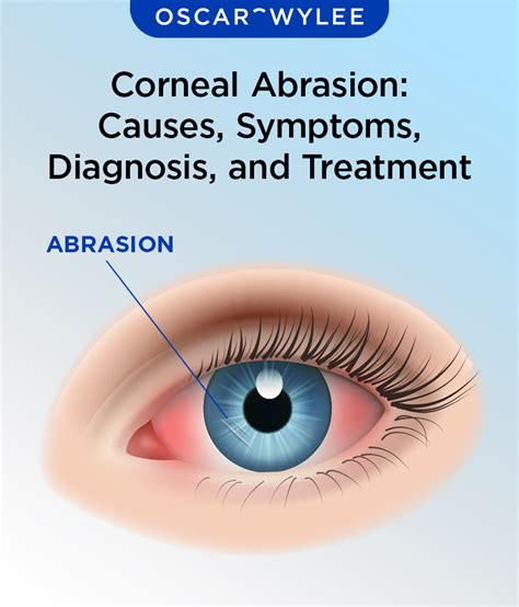 Symptoms, Causes, and Treatment of a Corneal Abrasion