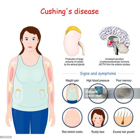 Symptoms and Info to Help with Cushing