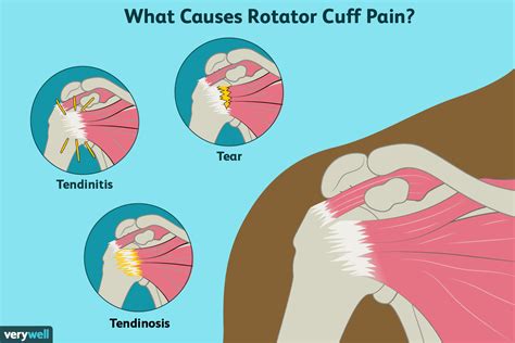 Symptoms and Signs of Rotator Cuff Injury - eMedicineHealth