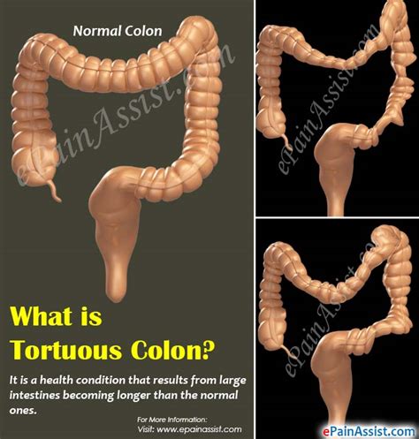 Symptoms of tortuous colon. Aug 28, 2023 · Learn about tortuous colon, a condition where the large intestines become longer and twisted, causing discomfort and constipation. Explore its causes, symptoms, and treatment options, including home remedies and medications, as well as the rare surgical procedure for severe cases. 