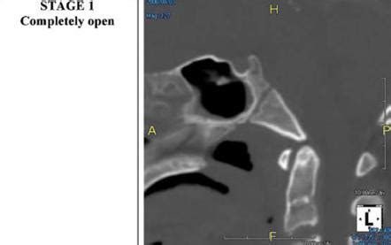 Synchondrosis Radiology Reference Article Radiopaedia.org