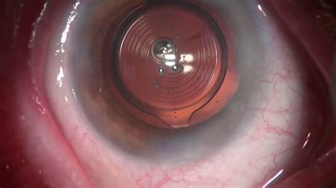 Synergy Toric IOL Implantation With Pupil Expander - Eyetube