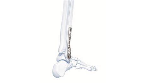 Our LCP™ Distal Ulna Plate is part of the DePuy Synthes L