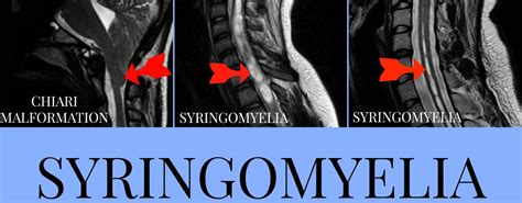Syringomyelia life expectancy. Background Syringomyelia and Chiari malformation are classified as rare diseases on Orphanet, but international guidelines on diagnostic criteria and case definition are missing. Aim of the study: to reach a consensus among international experts on controversial issues in diagnosis and treatment of Chiari 1 malformation and … 