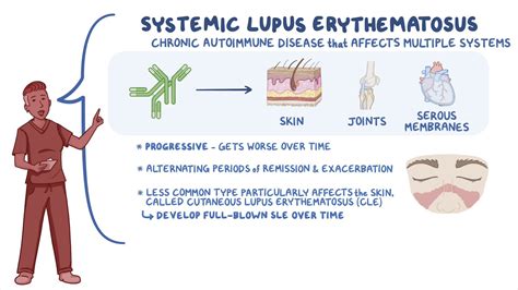 Systemic Lupus Erythematosus ACOG