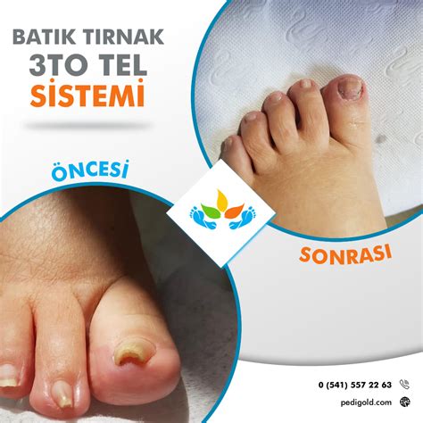 Tırnak Batığı (Batık Tırnak) Proeva Bakım Merkezi. 