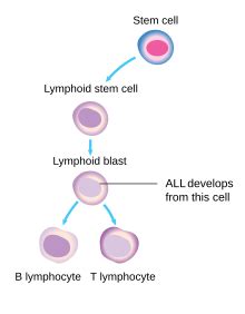 T-lineage acute lymphoblastic leukemia (T-ALL)