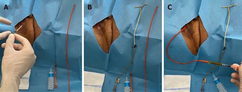 T-tube removal after liver transplantation: a new technique ... - LWW