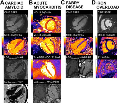 T1 mapping in cardiac MRI SpringerLink