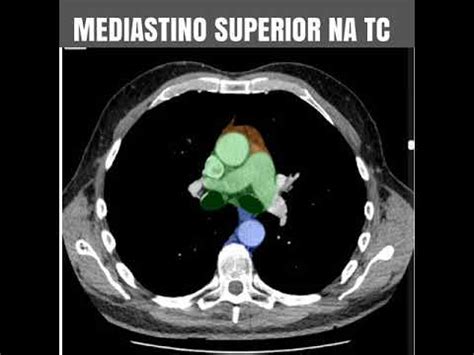 TAC Finestra da Mediastin