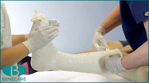 Taking Care of Your Plaster Cast - York and Scarborough Teaching ... - muktibox.com