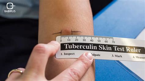 TB Test