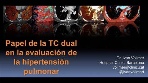 TC hipertensión