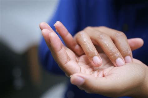Telapak Tangan Sering Berkeringat: Penyebab, Dampak, dan Cara ... - balustradellc