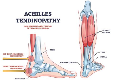Tendinitis Achilles – Apotek Mandjur - balustradellc