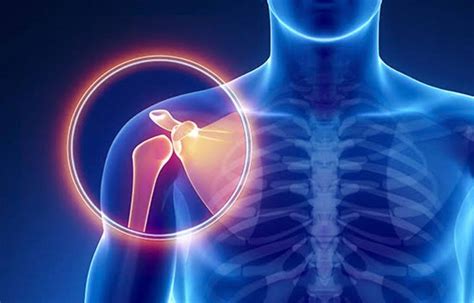 Terapi Nyeri Bahu karena Cedera - balustradellc