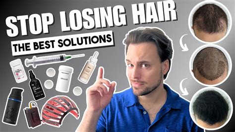 The Best Hair Loss Treatments for Men (2026) | Fortune - balustradellc