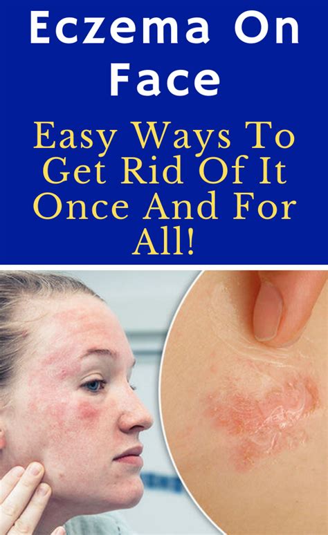The Best Ways To Deal With Eczema On Your Face - balustradellc