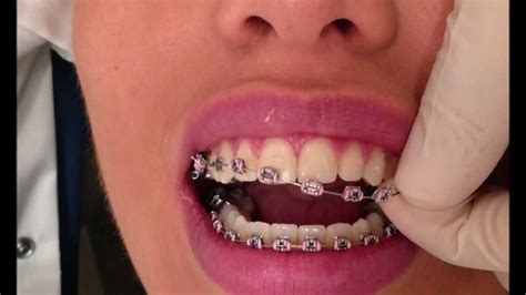 THE BRACES ARE COMING OFF! FULL BRACES IN LESS THAN ONE YEAR - YouTube