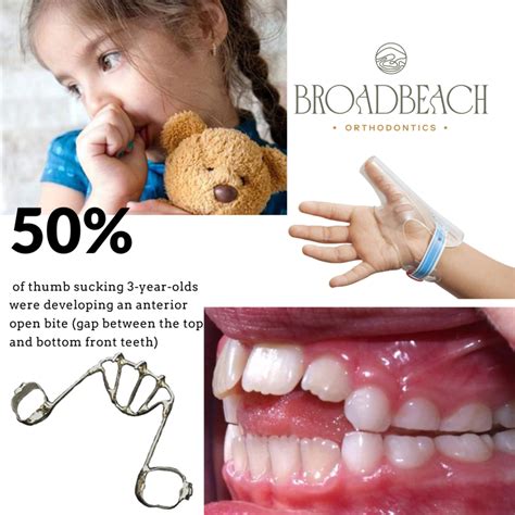 The Effects of Thumb Sucking and How to Stop It – Our Guide - balustradellc