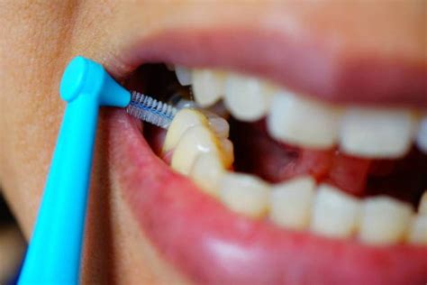 The Influence of Erosive and Abrasive Effects of Interdental Brushing ... - wintechmobiles.com