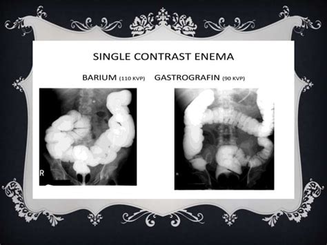 THE NEONATAL RESPONSE TO GASTROGRAFIN ENEMA