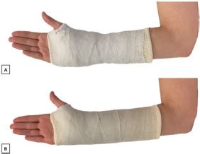 The past, present and future of the conservative treatment of distal ... - wintechmobiles.com