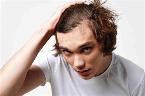 The Signs Of Balding At 20’s - Causes And Treatment Options - balustradellc