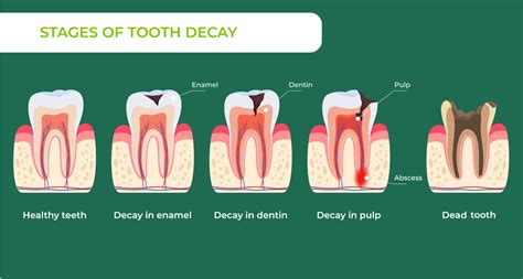 The Tooth Decay Process: How to Reverse It and … - balustradellc