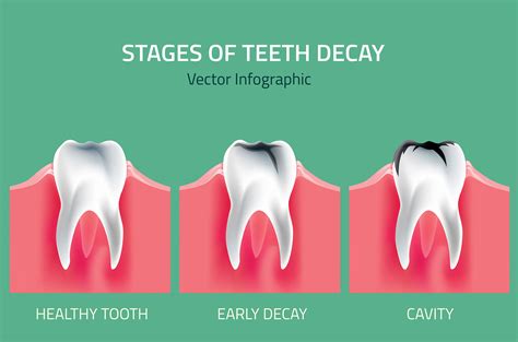 The Tooth Decay Process: How to Reverse It and Avoid a Cavity - balustradellc