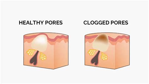 The Ultimate Guide to Unclogging Pores for Clearer Skin - balustradellc