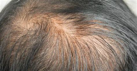 Thinning Hair in Men: Causes and Modern Treatments - balustradellc