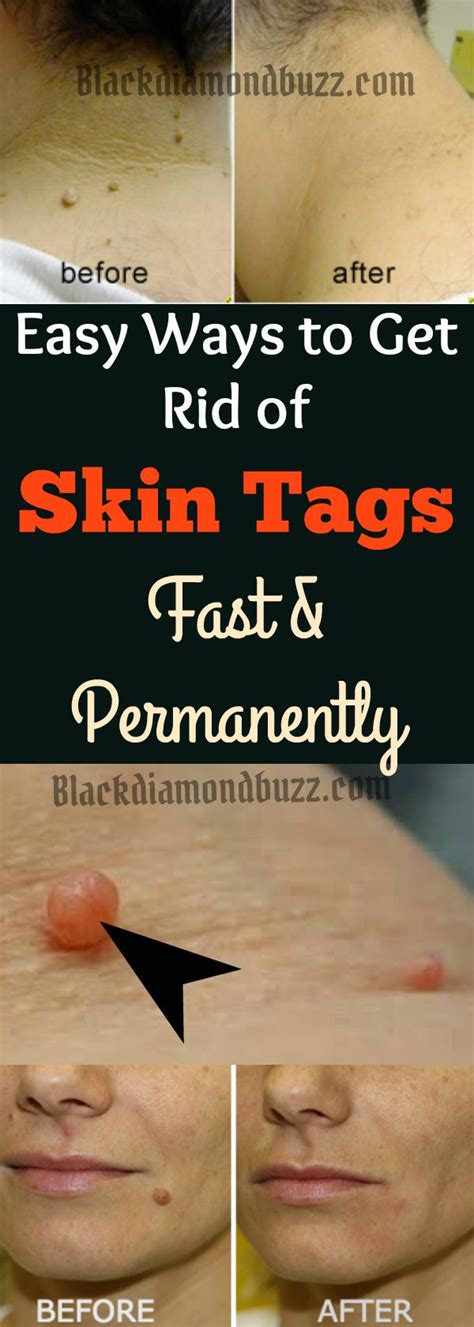This is how to get rid of skin tags FAST! - balustradellc