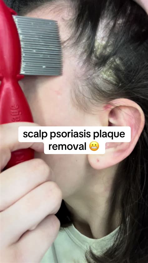 Tiktok Scalp Psoriasis Removal - balustradellc