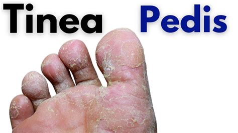 Tinea pedis - Penyebab, Gejala, Diagnosis, dan Pengobatan - balustradellc