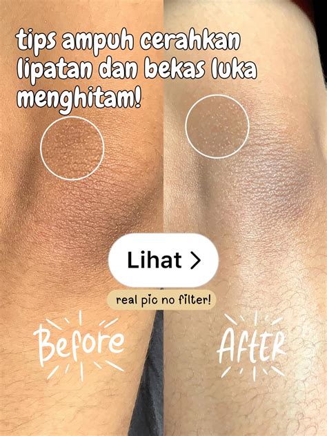 Tips Ampuh Hilangkan Bekas Luka Menghitam - Lemon8 - balustradellc