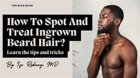 Tips for Treating and Healing Ingrown Beard Hair - balustradellc