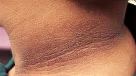 Tips Menghilangkan Daki di Lipatan Leher! - balustradellc