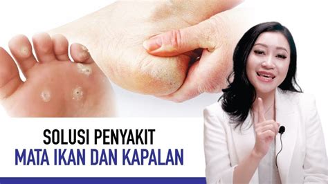 Tips Mudah Mengatasi Mata Ikan di Kaki - KlikDokter - balustradellc