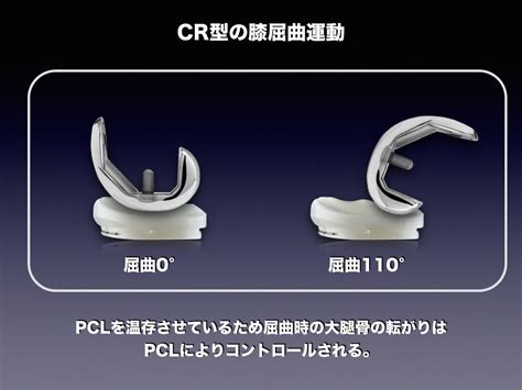 TKA-CR型とは │ 整形外科のいろいろ