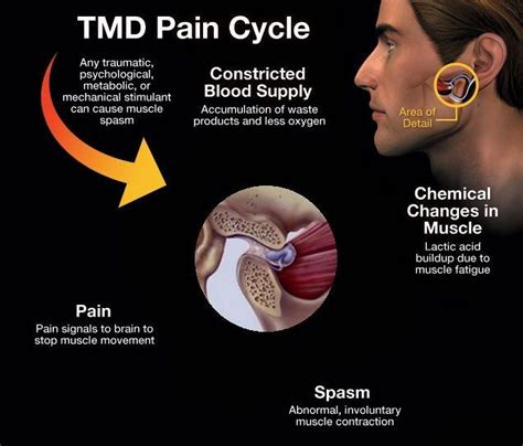 Full Download Tmj Remedies How To Treat And Reverse Temporomandibular Disorder Naturally  Without Drugs Or Surgery By John Quinn