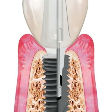 TNC - ITS. Implant