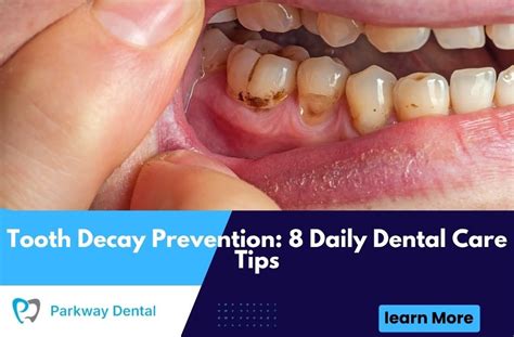 Tooth Decay Prevention: 8 Daily Dental Care Tips - balustradellc
