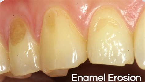 Tooth Enamel Erosion and Restoration - balustradellc