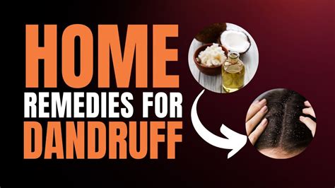 Top Natural Dandruff Remedies for Flake-Free Scalp - balustradellc