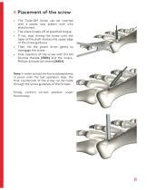 TOS Twist-Off Screw - I.T.S. - PDF Catalogs - MedicalExpo