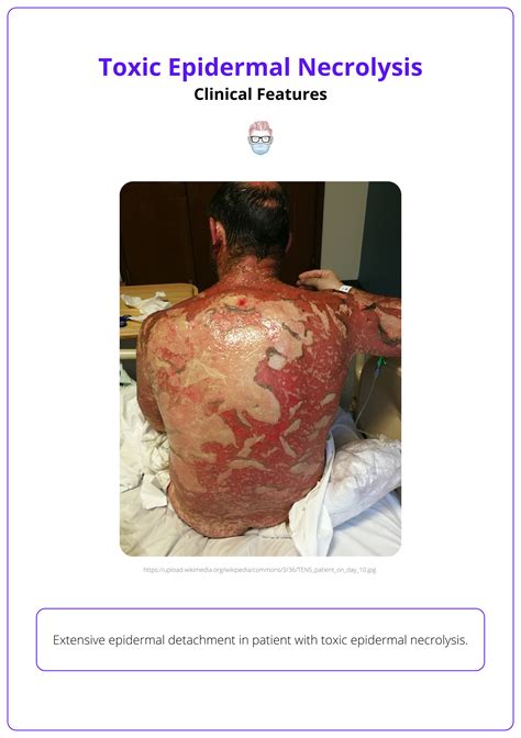 Toxic Epidermal Necrolysis – Apotek Mandjur - balustradellc