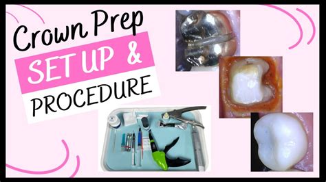 TRADITIONAL CROWN PREP SET UP & PROCEDURES // Tips For Dental ... - YouTube