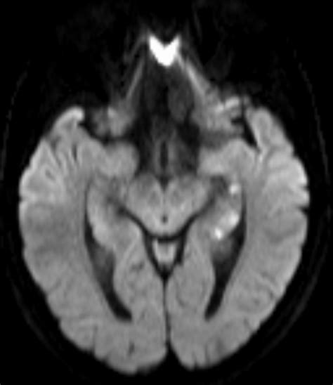 Transient global amnesia - Symptoms & causes - Mayo Clinic - wintechmobiles.com