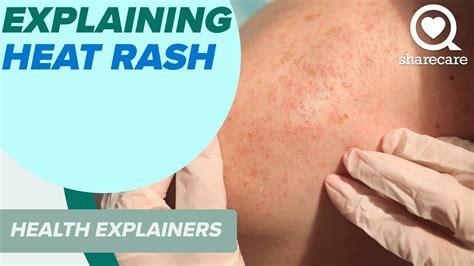 Treating Heat Rash - Prevention tips | Dr. Anju Methil - balustradellc
